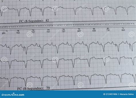 Electrocardiograma Ecg Ecg Con Arritmia Cardiaca Imagen De Archivo ...