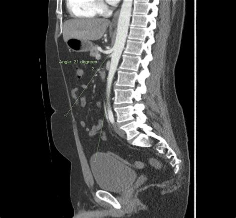 Often Overlooked Diagnosis: Median Arcuate Ligament Syndrome... : ACG Case Reports Journal