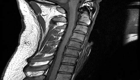 Regeneration of Nerve Connections after Spinal Cord Injury - PTEN Deletion - Neuroscience News