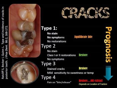 How To Improve Diagnosis, Prognosis and Treatment of the Cracked Tooth | Cracked tooth, Health ...