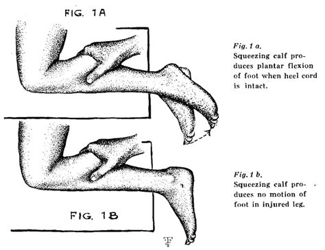 Simmonds-Thompson Test • LITFL • Medical Eponym Library