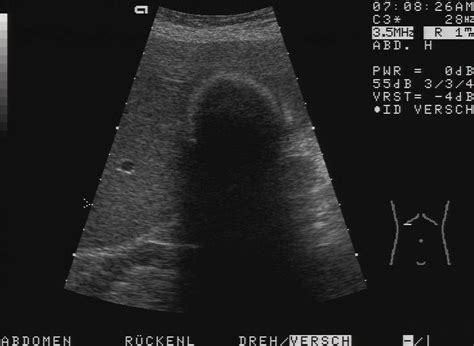 Typical picture of a porcelain gallbladder (calcification of the wall). Complete shadow in the ...