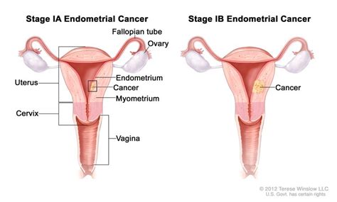 Endometrial Cancer Treatment - NCI