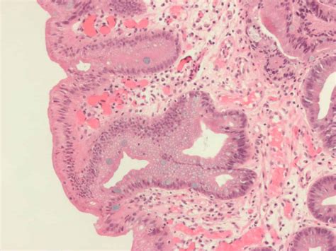 Barrett's Oesophagus - almostadoctor