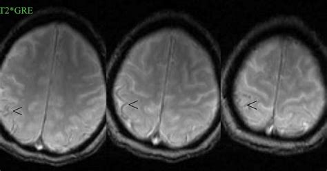 Dr Balaji Anvekar FRCR: Superficial Siderosis MRI T2*GRE Brain