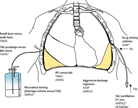 Malignant Pleural Effusion Diagnosis And Management | My XXX Hot Girl