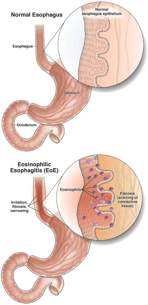 Eosinophilic esophagitis (EoE) - AGA GI Patient Center