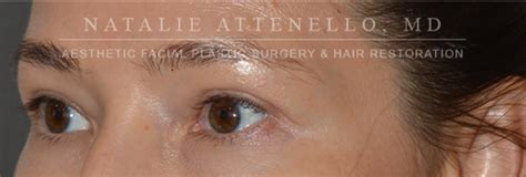 Beverly Hills Facelift Before and After Photos - Los Angeles Plastic ...