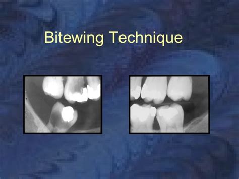 radiology-bitewing-technique