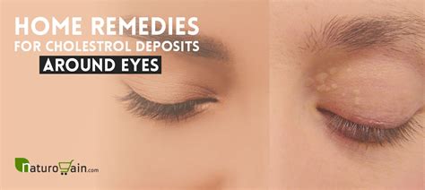 10 Natural Home Remedies For Cholesterol Deposits Around Eyes