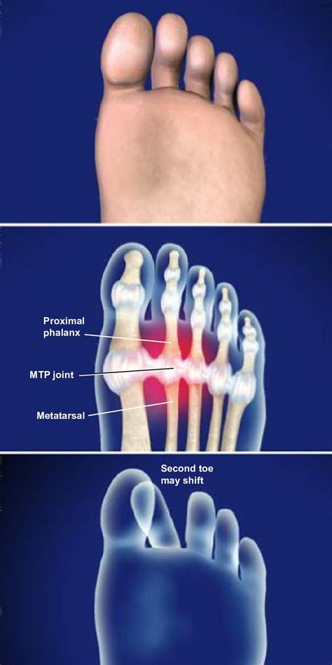 Great Toe Mtp Joint