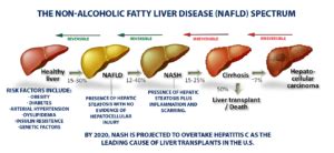 Fatty Liver Disease - Texas Liver Institute