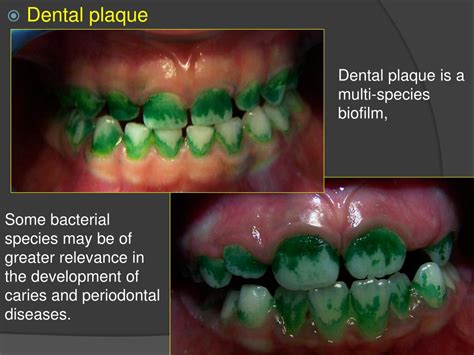 PPT - Dental plaque (bacteria biofilm ) - g enesis and structure ...