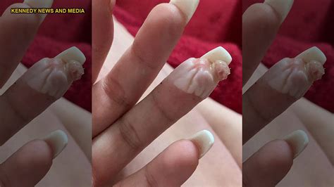 Woman claims botched acrylic nail job nearly cost her a finger: 'I'll ...