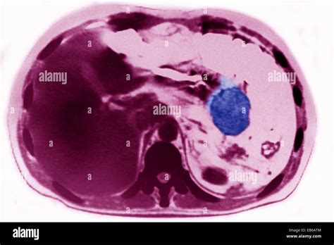 PANCREATIC CYST, CT SCAN Stock Photo - Alamy