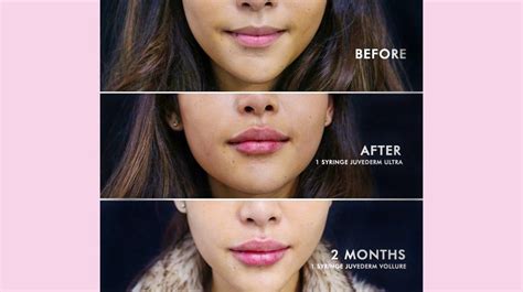 Restylane vs. Juvederm for Lips: What’s the Difference? Lip Injections Juvederm, Restylane Silk ...