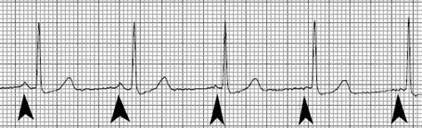 Atrial Ectopic Rhythm - equimedcorp