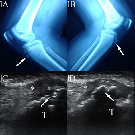 Cureus | Osgood-Schlatter Disease Unveiled Under High-frequency Ultrasonogram