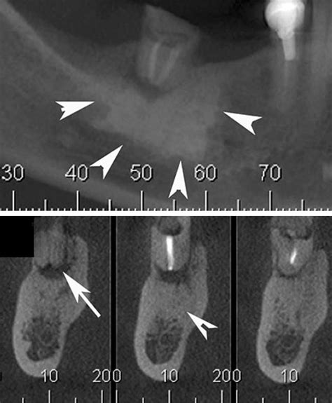 Condensing osteitis - Wikiwand