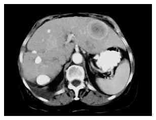 CT scan after TACE demonstrating an excellent distribution of lipiodol ...