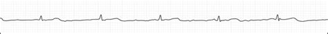 Understanding the Basics of an ECG/EKG