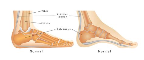 What Causes Heel Pain? – SAPNA: Spine and Pain Clinic of North America