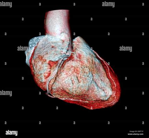 Coloured 3D computed tomography (CT) scan of the heart of a 54 year old patient. The right ...