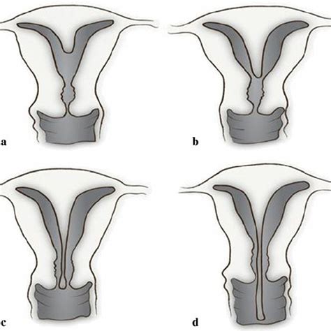 Septate uterus with double cervix ( a , b ). Resettoscopic metroplasty ...