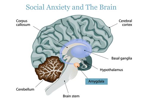 Causes of Social Anxiety – Bridges to Recovery