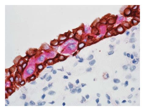 (a) Urothelial carcinoma in situ with strong full-thickness... | Download Scientific Diagram