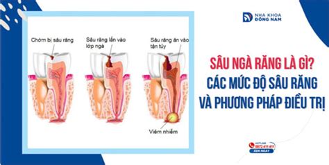 Sâu ngà răng là gì? Các mức độ sâu răng và phương pháp điều trị