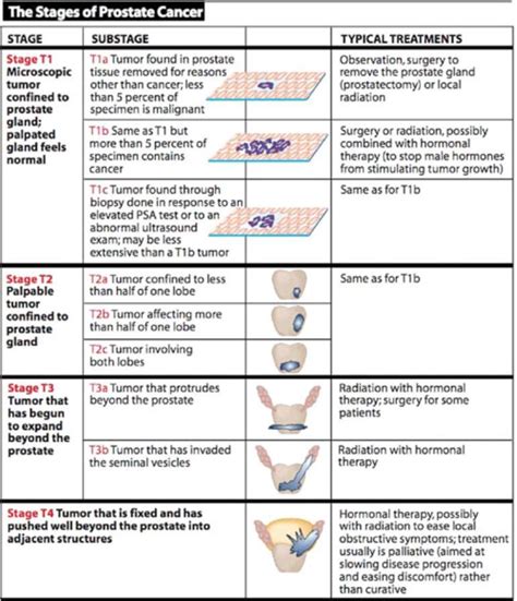 Prostate cancer stages