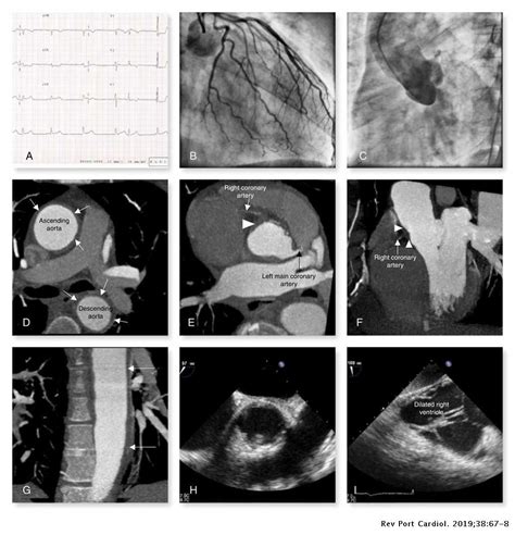 Cardiogenic shock due to sexually transmitted disease – A rare cause of acute myocardial ...