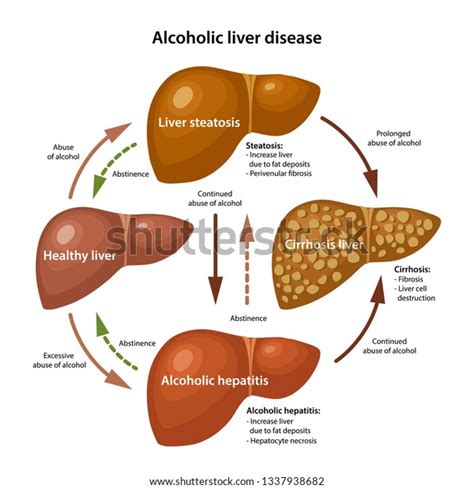 Cirrhosis As Related To Alcoholic Liver Disease Pictures