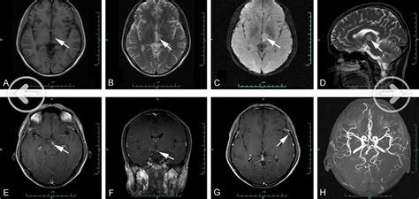 Figure 1 from Neurosyphilis presenting with characteristic MRI findings ...