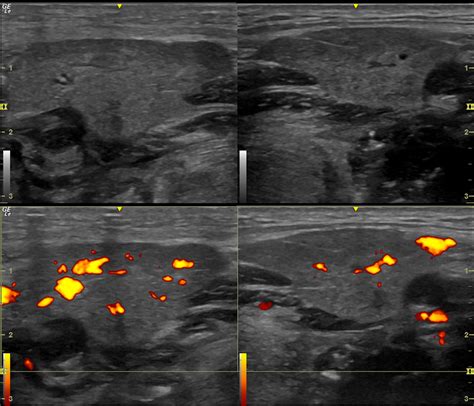 Swollen Submandibular Gland Ultrasound