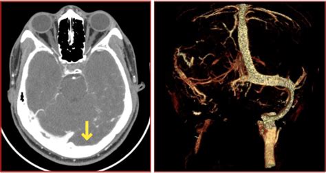 Annals of B-Pod: Dural Venous Sinus Thrombosis — Taming the SRU