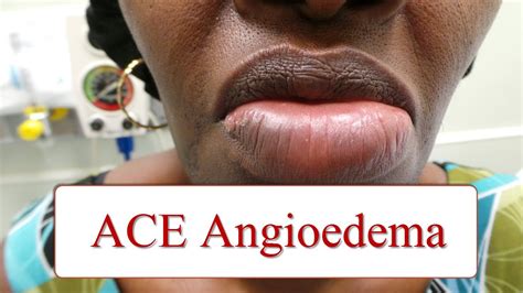 ACE Inhibitor Associated Angioedema - YouTube