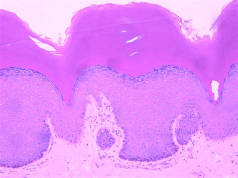 Stratified Squamous with Keratin