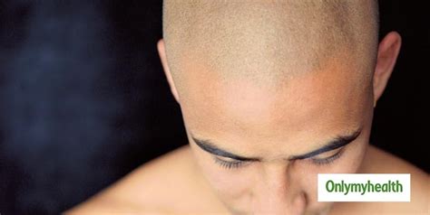 Can Bald People Get Dandruff? | OnlyMyHealth