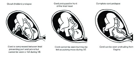 Knee Chest Position For Prolapsed Cord