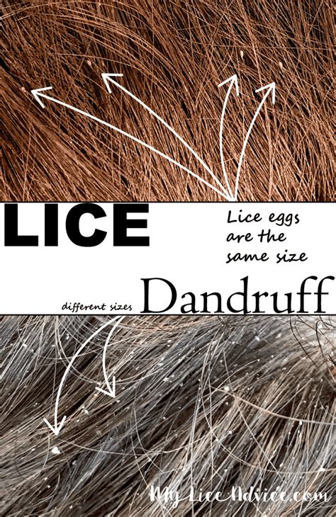 Lice vs Dandruff - 7 Key Differences Between Lice Eggs and Dandruff