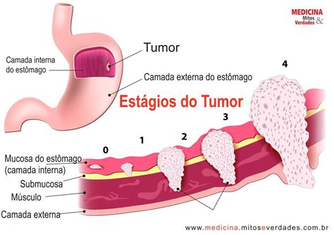 Causas do câncer de estômago | Medicina - Mitos e Verdades