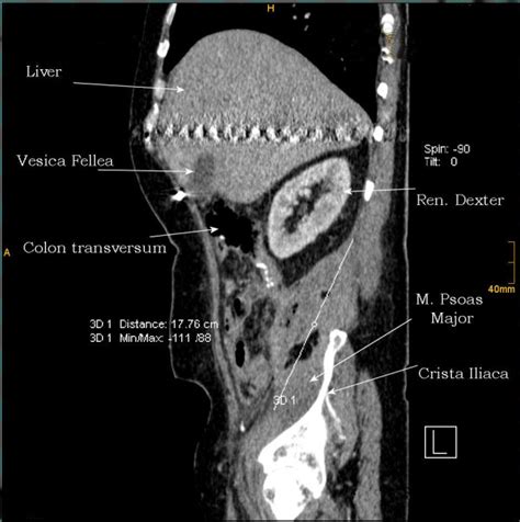 2nd case. CT - sagittal plan of a large retroperitoneal hematoma -... | Download Scientific Diagram