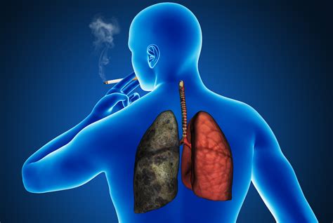 African Americans and Lung Cancer: A Bad Situation - Jay Harold