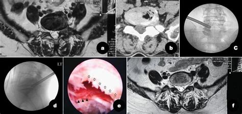 Case example of with FLDH who received TESSYS technique combined with ...