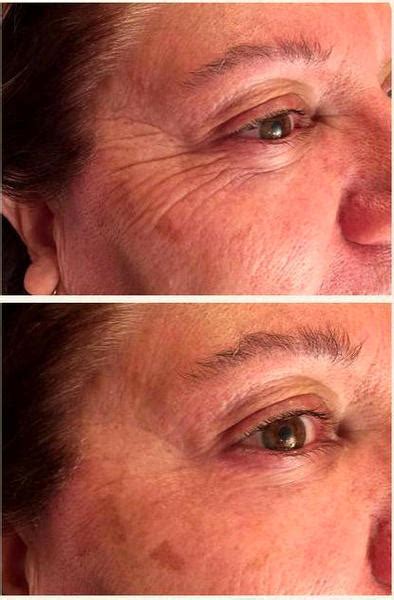 Botox Around Eyes Results » Facial Injections: Info, Prices, Photos ...