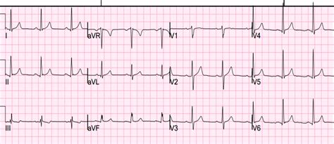 Dr. Smith's ECG Blog: Precordial ST depression. What is the diagnosis?