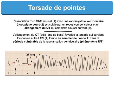 Torsade de pointes : e-cardiogram