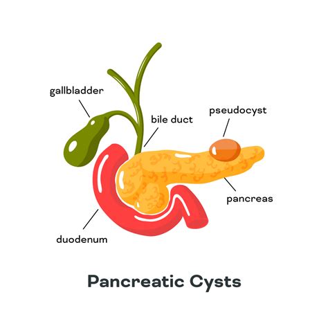 Pancreatic Cysts in Singapore - Gastrohealth Centre